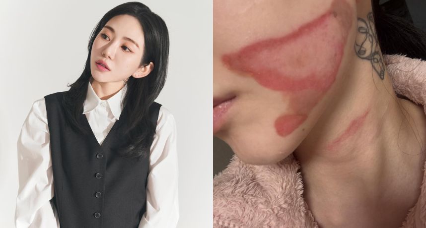 AOA 前成員權珉娥驚爆做醫美險毀容！「臉部二度燒燙傷」怒控診所失職將提告